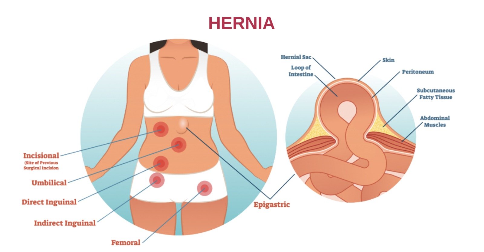 types of hernia