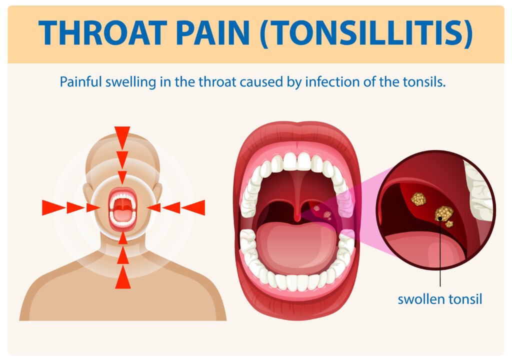 Tonsillectomy