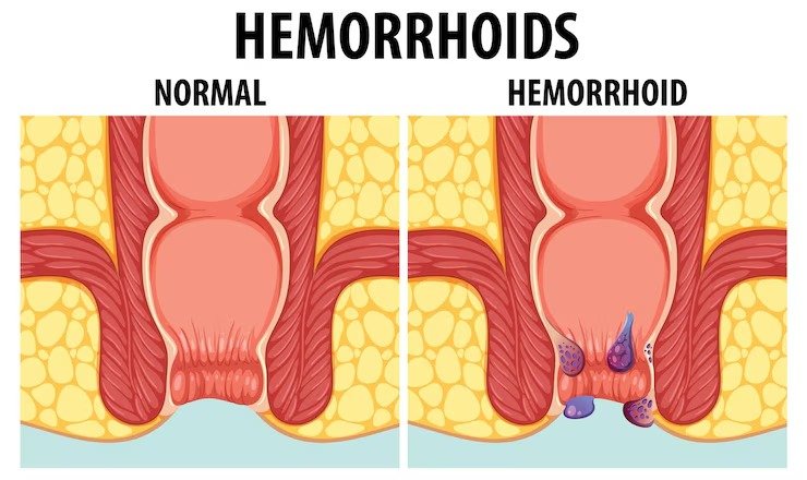 Comparing Normal and Internal Hemorrhoids