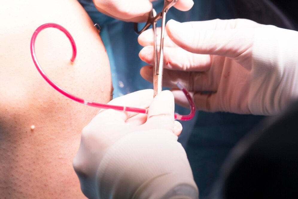 DJ stent removal