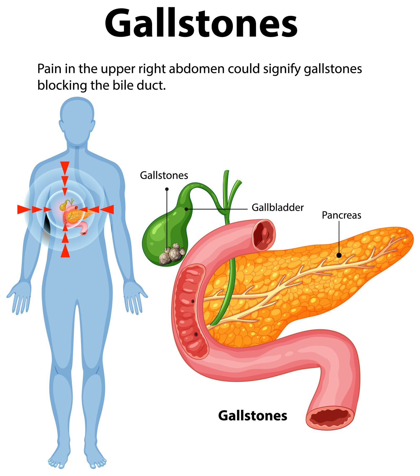 gall stone removal