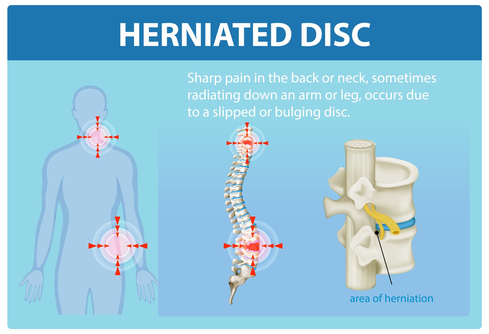 herniated disc