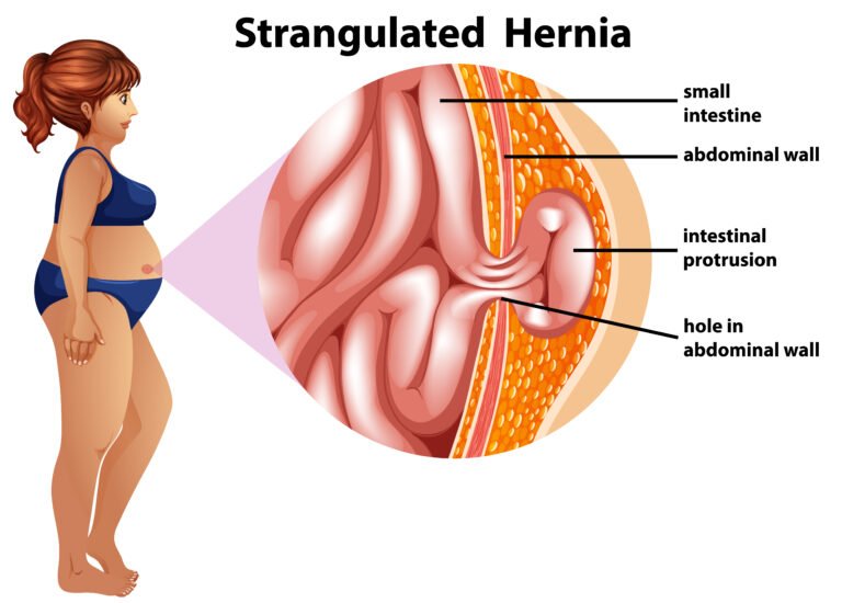 most common hernia in female