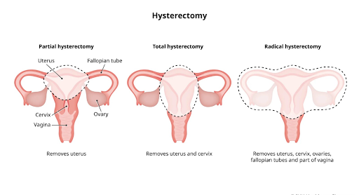 Hysterectomy steps