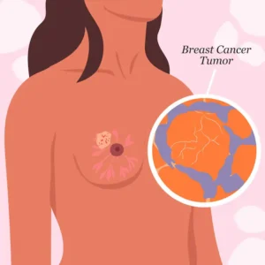 breast cancer found