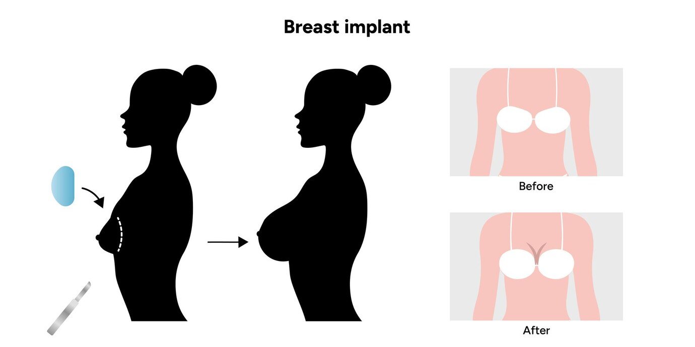 breast implant