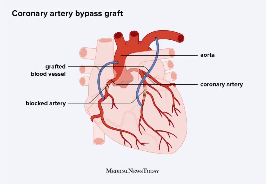 Coronary artery bypass surgery