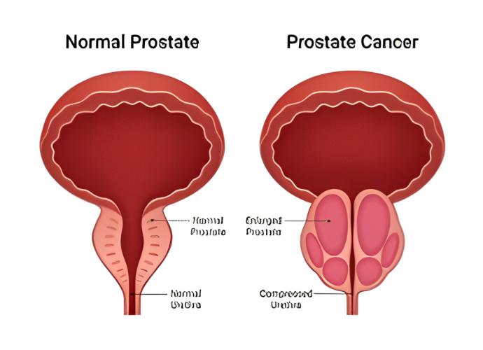 prostate surgery